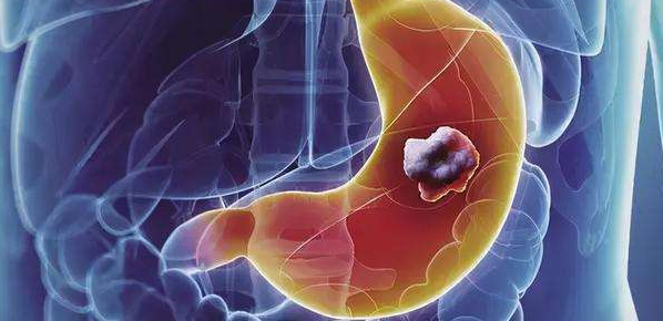 胃癌的发展演变过程有哪几步