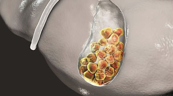 胆囊结石会变成胆囊癌吗
